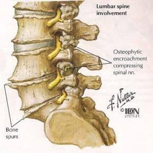 Spondylosis