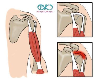 Biceps tendinitis