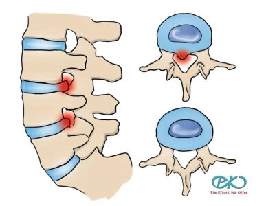 Herniated nucleus pulposus