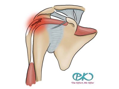 Rotator cuff tear2