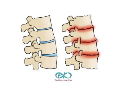 cervical spondylosis