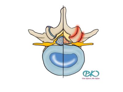 lumbar stenosis