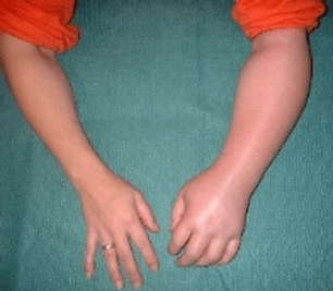 Shoulder hand syndrome